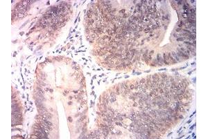 Immunohistochemical analysis of paraffin-embedded rectum cancer tissues using BRIP1 mouse mAb with DAB staining. (BRIP1 antibody  (AA 904-986))