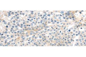 Immunohistochemistry of paraffin-embedded Human breast cancer tissue using TNFAIP8 Polyclonal Antibody at dilution 1:35 (TNFAIP8 antibody)