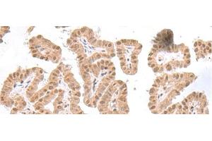 Immunohistochemistry of paraffin-embedded Human thyroid cancer tissue using TDP2 Polyclonal Antibody at dilution of 1:75(x200) (TDP2 antibody)