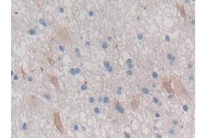 Detection of CTRB1 in Human Glioma Tissue using Polyclonal Antibody to Chymotrypsinogen B1 (CTRB1) (CTRB1 antibody  (AA 34-261))