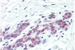 Human Breast (formalin-fixed, paraffin-embedded) stained with DFFA antibody ABIN461876 at 10 ug/ml followed by biotinylated goat anti-rabbit IgG secondary antibody ABIN481713, alkaline phosphatase-streptavidin and chromogen. (DFFA antibody  (AA 2-21))