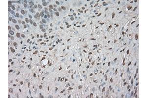Immunohistochemical staining of paraffin-embedded Adenocarcinoma of colon tissue using anti-BUB1Bmouse monoclonal antibody. (BUB1B antibody)