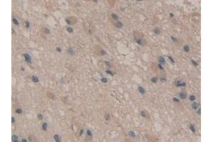 Detection of ATP1b3 in Human Glioma Tissue using Polyclonal Antibody to Sodium/potassium Transporting ATPase Subunit Beta-3 (ATP1b3)