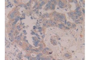 Detection of MAP2K6 in Human Breast cancer Tissue using Polyclonal Antibody to Mitogen Activated Protein Kinase Kinase 6 (MAP2K6) (MAP2K6 antibody  (AA 46-306))