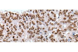 Immunohistochemistry of paraffin-embedded Human colorectal cancer tissue using XAB2 Polyclonal Antibody at dilution of 1:25(x200) (XAB2 antibody)