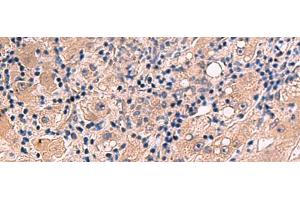Immunohistochemistry of paraffin-embedded Human liver cancer tissue using INSM2 Polyclonal Antibody at dilution of 1:35(x200) (INSM2 antibody)