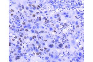 Paraformaldehyde-fixed, paraffin embedded Human lung, Antigen retrieval by boiling in sodium citrate buffer (pH6) for 15min, Block endogenous peroxidase by 3% hydrogen peroxide for 30 minutes, Blocking buffer at 37°C for 20min, Antibody incubation with Histone H2A. (H2AFZ antibody)