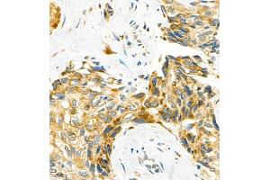 Immunohistochemistry of paraffin embedded human liver cancer using P4H (ABIN7074215) at dilution of 1:700 (400x lens) (HIF Prolyl Hydroxylase antibody)