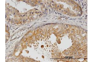 Immunoperoxidase of monoclonal antibody to ERBB2 on formalin-fixed paraffin-embedded human breast cancer. (ErbB2/Her2 antibody  (AA 22-121))