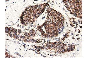 Immunohistochemical staining of paraffin-embedded Adenocarcinoma of Human breast tissue using anti-CLPP mouse monoclonal antibody.
