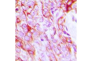 Immunohistochemical analysis of EGFR staining in human breast cancer formalin fixed paraffin embedded tissue section.
