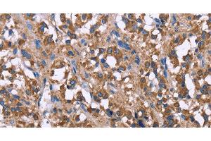 Immunohistochemistry of paraffin-embedded Human thyroid cancer using SERPINA1 Polyclonal Antibody at dilution of 1:30 (SERPINA1 antibody)
