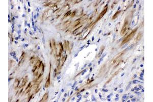 Cofilin 2 was detected in paraffin-embedded sections of human prostatic cancer tissues using rabbit anti- Cofilin 2 Antigen Affinity purified polyclonal antibody (Catalog # ) at 1 µg/mL. (Cofilin 2 antibody  (C-Term))