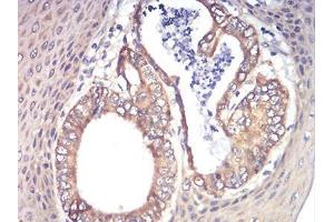 Immunohistochemical analysis of paraffin-embedded esophageal cancer tissues using RAD21 mouse mAb with DAB staining. (RAD21 antibody  (AA 287-403))
