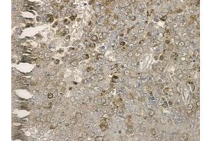 ABIN6255476 and ABIN6267169 at 1/100 staining human melanoma by IHC-P. (REPS1 antibody  (pSer709))