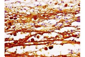 Immunohistochemistry of paraffin-embedded human melanoma using ABIN7160388 at dilution of 1:100