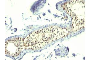 Formalin-fixed, paraffin-embedded human Testicular Carcinoma stained with Thymidylate Synthase Mouse Monoclonal Antibody (TS106). (TYMS antibody)