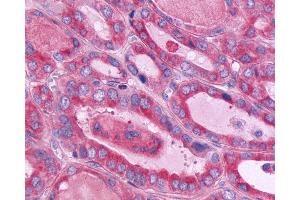 Anti-CD97 antibody IHC of human Thyroid, Follicular Carcinoma. (CD97 antibody  (Cytoplasmic Domain))