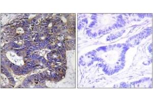 Immunohistochemistry analysis of paraffin-embedded human colon carcinoma tissue, using Collagen IV alpha2 Antibody. (COL4a2 antibody  (AA 151-200))