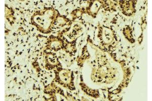 ABIN6274287 at 1/100 staining Human breast cancer tissue by IHC-P. (CEBPG antibody  (Internal Region))