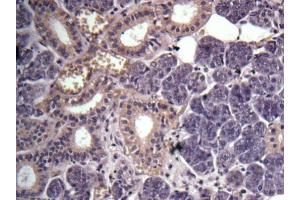 IHC-P Image Immunohistochemical analysis of human salivary gland cancer, using GPR114, antibody at 1:100 dilution. (GPR114 antibody)