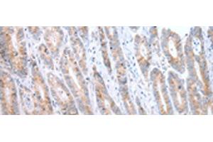 Immunohistochemistry of paraffin-embedded Human gastric cancer tissue using ATG16L1 Polyclonal Antibody at dilution of 1:40(x200) (ATG16L1 antibody)