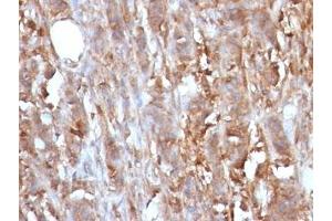 Formalin-fixed, paraffin-embedded human cervical carcinoma stained with Beta-2-Microglobulin antibody. (beta-2 Microglobulin antibody)