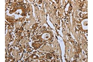 The image on the left is immunohistochemistry of paraffin-embedded Human gastic cancer tissue using ABIN7191969(PPARA Antibody) at dilution 1/30, on the right is treated with synthetic peptide. (PPARA antibody)