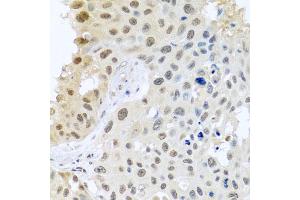 Immunohistochemistry of paraffin-embedded human lung cancer using DNAL1 antibody (ABIN5974658) at dilution of 1/100 (40x lens).