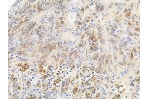 ABIN6256746 and ABIN6267646 at 1/100 staining human melanoma by IHC-P. (Cortactin antibody  (pTyr466))