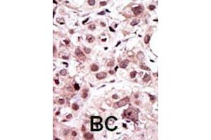 Formalin-fixed and paraffin-embedded human breast cancerreacted with AXL polyclonal antibody , which was peroxidase-conjugated to the secondary antibody, followed by AEC staining. (AXL antibody  (N-Term))
