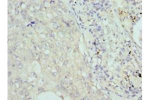 Immunohistochemistry of paraffin-embedded human lung cancer using ABIN7148039 at dilution of 1:100 (COCH antibody  (AA 20-260))