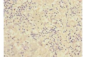 Immunohistochemistry of paraffin-embedded human liver cancer using ABIN7166553 at dilution of 1:100 (Protocadherin 1 antibody  (AA 60-220))