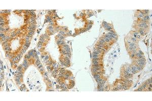 Immunohistochemistry of paraffin-embedded Human colon cancer tissue using SELENOM Polyclonal Antibody at dilution 1:50 (SELM antibody)