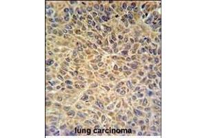 EXOC3L2 Antibody (N-term) (ABIN651216 and ABIN2840135) IHC analysis in formalin fixed and paraffin embedded human lung carcinoma followed by peroxidase conjugation of the secondary antibody and DAB staining. (EXOC3L2 antibody  (N-Term))