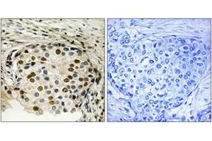 Immunohistochemistry analysis of paraffin-embedded human breast carcinoma, using OSR1 (Phospho-Thr185) Antibody. (OSR1 antibody  (pThr185))