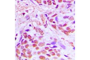 Immunohistochemical analysis of SRF staining in human breast cancer formalin fixed paraffin embedded tissue section. (SRF antibody  (Center))