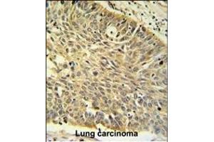 MTHFD1 Antibody (Center ) f IHC analysis in formalin fixed and paraffin embedded human Lung carcinoma followed by peroxidase conjugation of the secondary antibody and DAB staining.