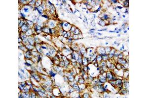 Anti-beta Catenin antibody, IHC(P): Human Mammary Cancer Tissue (CTNNB1 antibody  (N-Term))