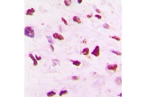 Immunohistochemical analysis of SKP2 staining in human lung cancer formalin fixed paraffin embedded tissue section. (SKP2 antibody  (C-Term))