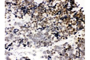 Anti-CTCF Picoband antibody, IHC(P) IHC(P): Human Lung Cancer Tissue (CTCF antibody  (AA 521-727))