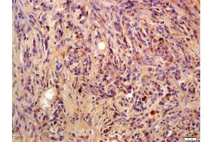Formalin-fixed and paraffin embedded human lung carcinoma labeled with Anti-Phospho-BLNK(Tyr96) Polyclonal Antibody, Unconjugated (ABIN683458) at 1:200 followed by conjugation to the secondary antibody and DAB staining (B-Cell Linker antibody  (pTyr96))