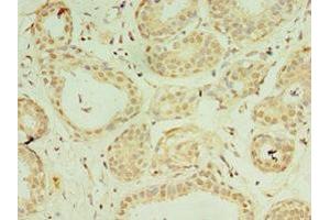 Immunohistochemistry of paraffin-embedded human breast cancer using ABIN7156912 at dilution of 1:100 (IL-37 antibody  (AA 1-218))