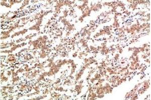 Immunohistochemistry of paraffin-embedded Human lung carcinoma tissue using JAK2 Monoclonal Antibody at dilution of 1:200. (JAK2 antibody)