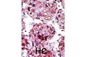 Formalin-fixed and paraffin-embedded human hepatocellular carcinoma tissue reacted with HK1 polyclonal antibody  , which was peroxidase-conjugated to the secondary antibody, followed by AEC staining. (Hexokinase 1 antibody  (N-Term))