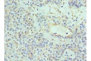 Immunohistochemistry of paraffin-embedded human breast cancer using ABIN7161741 at dilution of 1:100 (NTRK3 antibody  (AA 40-300))