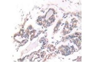 IHC-P analysis of Human Breast Cancer Tissue, with DAB staining. (IFNA5 antibody  (AA 22-189))