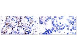 Immunohistochemical analysis of paraffin-embedded human breast carcinoma tissue using c-Jun (Ab-91) antibody (E021021). (C-JUN antibody)