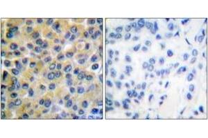 Immunohistochemistry analysis of paraffin-embedded human breast carcinoma tissue, using SHP-2 (Ab-580) Antibody. (PTPN11 antibody  (AA 546-595))
