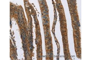 Immunohistochemistry of Human colon cancer using CAST Polyclonal Antibody at dilution of 1:70